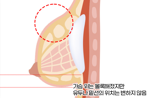 보형물 삽입 후 가슴 위쪽 볼륨과 유두 및 밑선 위치 설명