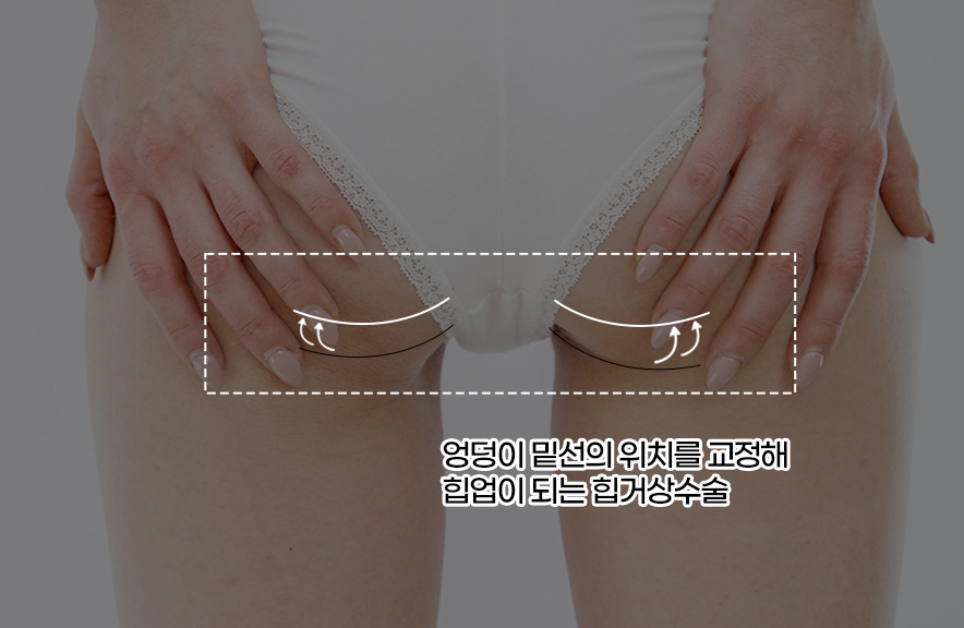 엉덩이 밑선의 위치리를 교정해 힙업이 되는 힙거상수술