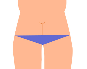 피부 표면으로 실밥이 보이지 않는 봉합